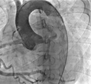 Nacimiento normal de la coronaria derecha a partir de la aorta; no se observa el nacimiento de la coronaria izquierda a partir de ésta.