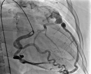Nacimiento anómalo de la arteria coronaria izquierda a partir del tronco de la arteria pulmonar, configurando el síndrome de ALCAPA.