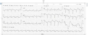 A la izquierda EKG de ingreso en el que se observa taquicardia sinusal, onda S profunda en DI, onda Q e inversión de onda T en DIII – S1Q3T3 (ver flechas), eje desviado a la derecha.