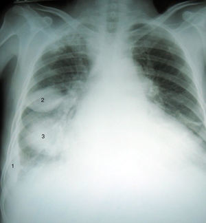 Radiografía posteroanterior de tórax (Día 0, al ingreso) que muestra cardiomegalia, engrosamiento pleural derecho periférico (1) y dos imágenes de tipo masa en tercios medio (2) e inferior (3) derechos. Opacidad intersticial en bases.