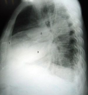 Radiografía lateral de tórax (Día 0, al ingreso) en la que se observa que las masas corresponden a líquido en las cisuras menor (2) y mayor (3) derechas. Persiste engrosamiento pleural (1).