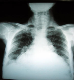 Radiografía antero-posterior de tórax (Día 30 posterior al tratamiento diurético e inodilatador) que muestra resolución parcial de los engrosamientos pleurales y persiste cardiomegalia.