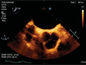 Ecocardiografía transesofágica en la que se aprecia gran vegetación en electrodo de la aurícula derecha de 4 x 9 milímetros.
