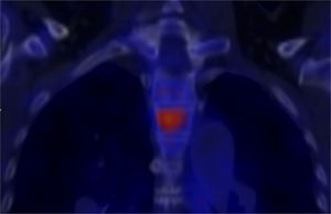 PET CT con FDG-F18 que evidencia aumento anormal del metabolismo en el tercer cuerpo vertebral torácico de manera moderada a severa, sin alteraciones morfológicas asociadas. Los hallazgos sugieren proceso inflamatorio – infeccioso.