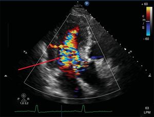 Ecocardiograma transtorácico en vista apical tres cámaras con Doppler color. La flecha muestra jet de regurgitación aórtica grave, secundaria a dilatación de la raíz aórtica.