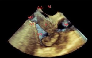 Proyección esófago superior 45° modificada para enfocar la lesión (*). AD: aurícula derecha, VT: válvula tricuspídea, VD: ventrículo derecho, VA: válvula aórtica, AI: aurícula izquierda, SIA: septum interauricular.