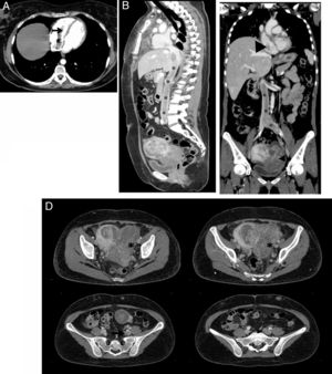 Tomografía de tórax y abdomen en fase venosa, A. Corte axial. Trombo que ocupa la aurícula (asterisco) y el ventrículo (flecha) derechos. B. Corte sagital. Masa que ocupa la vena cava inferior en toda su extensión (asteriscos) C. Corte coronal. Masa que ocupa la vena ilíaca común izquierda y la cava inferior (asteriscos), y que se extiende hasta la aurícula derecha (flecha). Se observa además una masa uterina que corresponde a mioma. D. Cortes axiales. Masa uterina que corresponde a mioma (asteriscos) y masa que ocupa y dilata las venas ilíaca interna (flecha) y común (cabeza de flecha) izquierdas.