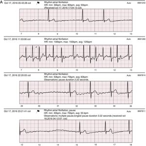 A: Sample SEEQ tracings. Patient with atrial fibrillation not previously diagnosed by Holter monitoring, with multiple tracings at different hours of the same day; the flag sign in the first tracing corresponds to an automatic system report sent as an alert due to the low heart rate and arrhythmia. B: Extreme symptomatic daytime sinus bradycardia. C. 2:1 AV block in an awake patient with a history of syncope of unknown origin.