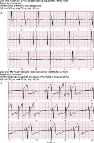 A: Sample SEEQ tracings. Patient with atrial fibrillation not previously diagnosed by Holter monitoring, with multiple tracings at different hours of the same day; the flag sign in the first tracing corresponds to an automatic system report sent as an alert due to the low heart rate and arrhythmia. B: Extreme symptomatic daytime sinus bradycardia. C. 2:1 AV block in an awake patient with a history of syncope of unknown origin.