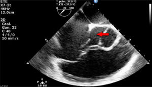 Válvula aórtica bicúspide que evidencia pérdida de la continuidad entre el seno no coronariano y la aurícula derecha.
