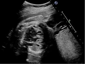 Cardiomegalia y derrame pericárdico (DP) en feto con agenesia de ductus venoso con drenaje de vena umbilical a aurícula derecha (AD). AI: auricula izquierda.