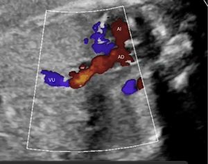 Agenesia de ductus venoso con drenaje directo de vena umbilical (VU) a aurícula derecha (AD). AI: aurícula izquierda.