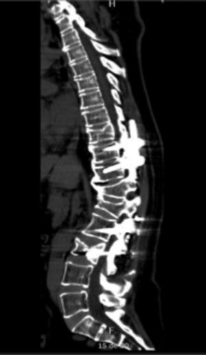 Tomografía computarizada de columna vertebral, corte sagital, en la que se evidencian tornillos transpediculares en vértebras torácicas 10 – 11 y lumbares L2 – L3; hipercifosis residual a nivel de fractura por acuñamiento en los cuerpos vertebrales T12-L1; disminución de la altura del cuerpo vertebral L3; espondilosis de columna torácica y lumbar y disminución de la matriz ósea.
