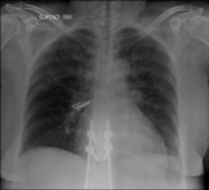 Radiografía de tórax que evidenciaba cardiomegalia e imágenes radiodensas en el hilio derecho de etiología por precisar, además de pequeños derrames pleurales bilaterales y cambios posquirúrgicos a nivel de columna dorsolumbar con presencia de material de artrodesis.