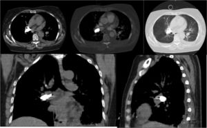 Tomografía de tórax que muestra hallazgos compatibles con cuerpo extraño con densidad metálica a nivel del hilio pulmonar derecho en relación con embolia pulmonar aguda que compromete la arteria lobar superior izquierda y algunas ramas subsegmentarias; además derrame pleural asociado a áreas de atelectasia pasiva con patrón de vidrio deslustrado bilateral, más artrodesis de la columna dorso-lumbar.
