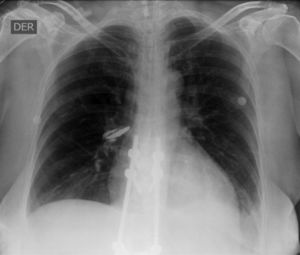 Radiografía de tórax en la que se aprecia obliteración del ángulo costo-diafragmático izquierdo, sugestivo de derrame pleural de apariencia libre. Catéter venoso central. Tubo traqueal central en posición adecuada.