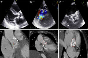 (A) Ecocardiograma bidimensional en el que se observa válvula aórtica calcificada, hipertrofia ventricular concéntrica y calcificación de la valva posterior de la mitral. (B) Ecocardiograma color que muestra cortocircuito entre el seno de Valsalva no coronariano a la aurícula derecha. (C) Ecocardiograma eje corto que muestra deformidad del seno de Valsalva y calcificación aórtica. (D, E, F) Angio-tomografia de corazón y aorta en la que se corrobora ruptura del seno no coronariano a la aurícula derecha y diferentes medidas necesarias para implante de la prótesis.