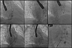 Procedimiento intervencionista del cierre de la ruptura del seno de Valsalva. (A) Paso de la guía vía arteria radia derecha a la aurícula derecha. (B) Se atrapa la guía con el Snare y se extrae por vía vena femoral derecha. (C) Se crea un asa con la guía entre arteria radial y vena femoral (D). Vía femoral izquierda se pasa catéter con el sistema de liberación del dispositivo de cierre. (E, F) Colocación y liberación del dispositivo cerrando la ruptura.