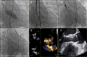 Procedimiento de implante de válvula aórtica transcateterismo (A). Valvuloplastia previa (B, C y D). Colocación y liberación de la válvula auto-expandible Corevalve®. (E, F) Imágenes del ecocardiograma intra-procedimiento en el que se corrobora la colocación adecuada y el funcionamiento de la prótesis aórtica.