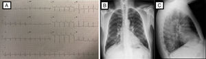 Estudios al Ingreso. A) Electrocardiograma: Taquicardia sinusal, eje -10°C, rS en DIII, aVF, pobre progresión r de V1-V3, Duración de PR, QRS y QTc normal, no elevación ST, depresión del ST de V4-V6. B y C) Radiografía de tórax PA y lateral: índice cardiotorácico normal, leve reforzamiento vascular parahiliar bilateral, infiltrado intersticial escaso bilateral y escaso derrame izquierdo posterior.