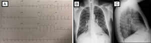 Estudios al Ingreso. A) Electrocardiograma: Taquicardia sinusal, eje -10°C, rS en DIII, aVF, pobre progresión r de V1-V3, Duración de PR, QRS y QTc normal, no elevación ST, depresión del ST de V4-V6. B y C) Radiografía de tórax PA y lateral: índice cardiotorácico normal, leve reforzamiento vascular parahiliar bilateral, infiltrado intersticial escaso bilateral y escaso derrame izquierdo posterior.