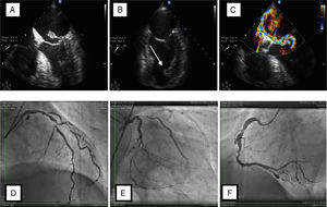 Ecocardiografía A) Ecocardiografía transesofágica, eje a 31°, prolapso de cabeza músculo papilar con cuerdas tendinosas en la aurícula izquierda. B) Ecocardiografía transesofágica, eje 53°, dos cámaras ; se aprecia músculo papilar anterior amputado (flecha blanca). C) Ecocardiografía transesofágica con doppler color, eje 31°, insuficiencia mitral anterior severa. Coronariografía D) Proyección oblicua con craneal, lesión estenótica de 60% de la arteria descendente anterior a nivel de la bifurcación de la segunda diagonal y en porción distal del 80%, la primera con lesión del 80% proximal y segunda diagonal con lesión del 70% proximal. E) Proyección 10° derecho y caudal 30°, arteria circunfleja con ostium independiente, primera obtusa marginal con lesión del 99% y flujo TIMI II, circunfleja con lesión en tercio medio a nivel de bifurcación de la tercera obtusa marginal del 93%. F) Proyección oblicua izquierda a 45 grados, arteria coronaria derecha dominante con lesiones difusas, arteria descendente posterior y arteria posterolateral con lesiones del 50% a nivel de la bifurcación.