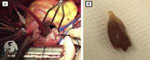 Pieza quirúrgica. A) Fotografía de ruptura de músculo papilar anterior (flecha azul). B) Fotografía de ruptura del músculo papilar extraído.