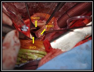 Cirugía cardíaca en la que se observa la válvula aórtica con sus tres senos de Valsalva: coronariano derecho (SVCD), coronariano izquierdo (SVCI) y no coronariano (SVNC); en éste último destaca la presencia de un aneurisma roto hacia la aurícula derecha, previo a su reparación.
