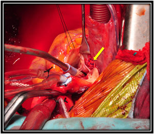 Cirugía a corazón abierto en la que se observa el seno de Valsalva no coronariano reparado con un parche de pledget de pericardio (flecha).