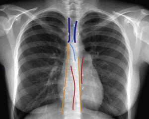 Líneas, bandas e interfaces del mediastino Esquema de radiografía de tórax con líneas, bandas e interfaces. Representación de líneas de unión superior-posterior e inferior-anterior (1); Líneas paraespinales (2), bandas paratraqueales (3) e interfaces azygo-aesofáceas y paraórticas (4).