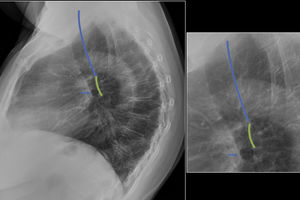 Radiografía lateral de la anatomía hiliar Radiografía lateral que muestra la anatomía hiliar parcial. La pared posterior de la tráquea (línea azul) es visible en la parte superior. El bronquio del lóbulo superior derecho (flecha azul) puede ser visto como una lucencia ovalada dentro de la sombra hiliar superior. Debajo de la pared posterior de la tráquea, la pared posterior del bronquio intermedio (línea verde) es visible al nivel de su bifurcación.