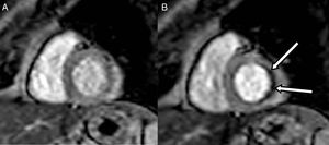 A) Resonancia nuclear magnética de reposo en mujer de 48 años con dolor coronario agudo con angiografía invasiva que no demostró enfermedad coronaria obstructiva. B) Resonancia nuclear magnética post-estrés con adenosina, en la misma mujer, que muestra isquemia subendocárdica (flechas).