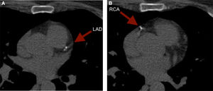 (A and B) Punctuate calcium deposits. LAD: left anterior descending artery; RCA: right coronary artery.