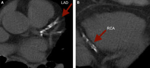 (A and B) Extensive calcification of the proximal LAD and distal RCA. LAD: left anterior descending artery; RCA: right coronary artery.