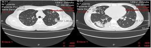 Tomografía axial computarizada de tórax de control, en la que se evidencian lesiones nodulares en ambos campos pulmonares, con distribución vascular y consolidación basal derecha posterior.