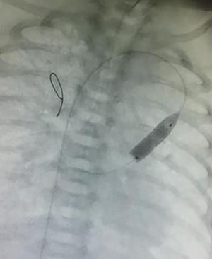 Implantación de stent en vena vertical.
