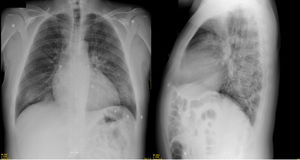 Infiltrados intersticiales pulmonares bilaterales.