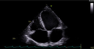 Dilatación ventricular con disfunción sistólica severa.