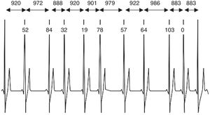 Ejemplo de un trazado de ECG con más de once complejos QRS. Se muestran los tiempos de intervalo R-R y la diferencia entre los intervalos R-R adyacentes. Fuente: Achten et al., 2003 (5).