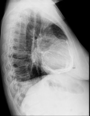 Radiografía lateral de tórax que muestra calcificación pericárdica difusa.