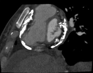 Tomografía computarizada de tórax con calcificación pericárdica difusa y compromiso de la válvula mitral.