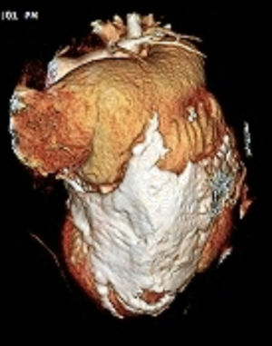 Reconstrucción tridimensional cardiaca en la que se evidencia la calcificación pericárdica con compromiso miocárdico del ventrículo izquierdo.