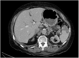 En fase portal de tomografía de abdomen contrastada se observan infartos esplénicos mútiples.