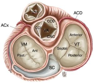 Anatomía de la válvula tricúspide. VT: válvula tricúspide, VM: válvula mitral, VA: válvula aórtica, VP: válvula pulmonar, SC: seno coronario, CCI: cúspide coronariana izquierda, CCD: cúspide coronariana derecha, CNC: cúspide no coronariana, ACx: arteria circunfleja, ACD: arteria coronaria derecha.