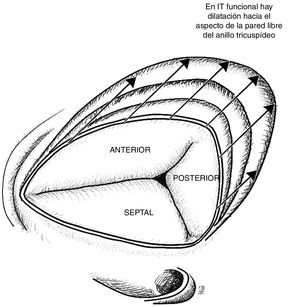 Válvula tricúspide vista desde la aurícula derecha. En la insuficiencia tricúspide funcional se evidencia dilatación progresiva del anillo hacia su aspecto anterior y posterior afectando progresivamente la coaptación, lo cual empeora la insuficiencia. Basado en estudio de Ton-Nu et al.17.