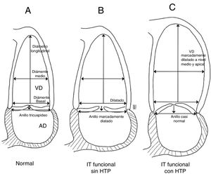 Remodelación de las cavidades derechas en insuficiencia tricúspide funcional en pacientes con y sin hipertensión pulmonar. Esquema A: representa un ventrículo derecho normal. Esquema B: muestra como en pacientes con patología del lado izquierdo sin HTP se dilata significativamente el anillo tricúspide y el diámetro basal del ventrículo derecho evitando la coaptación adecuada de las valvas durante la sístole. Esquema C: en pacientes con HTP, el diámetro del anillo tricúspide se conserva pero la dilatación y el remodelado excéntrico medio-apical del ventrículo llevan a traccionamiento apical de las valvas y aumento en la altura de coaptación; debido a esto se genera la insuficiencia tricúspide. Basado en el estudio de Topilsky et al18.