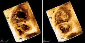 Imagen 3D de la válvula tricúspide obtenida en el laboratorio de la Fundación Cardioinfantil durante un Eco transtorácico empleando la herramienta de volumen completo en proyección apical de 4 cámaras y vista de frente desde el ventrículo derecho. A la izquierda en diástole ventricular y a la derecha en sístole. VT: válvula tricúspide. VM: válvula mitral. P: valva posterior tricúspide. S: valva septal. A: valva anterior.
