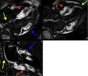 Resonancia magnética cardiaca – Secuencias de realce tardío: Importante depósito focal de gadolinio transmural comprometiendo los segmentos basales y medios del septum y de la pared inferior (flechas rojas), así como los segmentos basales de la pared anterolateral y anterior (flechas azules). Depósito focal de gadolinio subendocárdico a nivel del segmento apical del septum (flecha verde). Depósito focal de gadolinio comprometiendo la pared de la aurícula izquierda y el septum interauricular (flechas amarillas). FCI – IC.