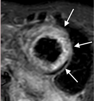 Resonancia magnética cardiaca – secuencias STIR: Aumento en la intensidad de señal a nivel de los segmentos medios de la pared anterior, anterolateral e inferolateral compatible con edema miocárdico (flechas blancas).