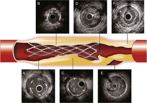 Problemas con el implante de stent detectados por IVUS. A, Malaposición en la que se evidencia un espacio entre el borde del stent (flechas) y la pared del vaso. B, Subexpansión del stent en comparación con diámetros de referencia. C, Proloapso de tejido (trombo, placa o ambos) dentro del stent. D, Disección del borde, disrupción de la placa (flecha) en el borde. E, Hematoma intramural, sangre en la media de la arteria (flechas). F, Carga de placa residual significativa. Tomado de: Intravascular Ultrasound: Textbook of Interventional Cardiology. 6th. edition.